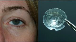 A Woman Had A Contact Lens Stuck In Her Eye For 28 Years and Did Not Notice At All