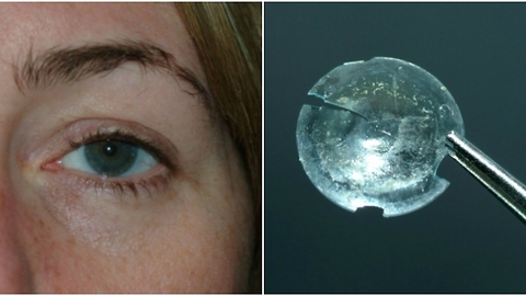 A Woman Had A Contact Lens Stuck In Her Eye For 28 Years and Did Not Notice At All