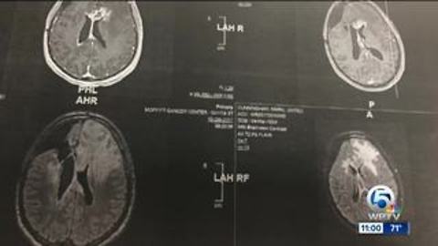 More St. Lucie County Glioblastoma patients come forward