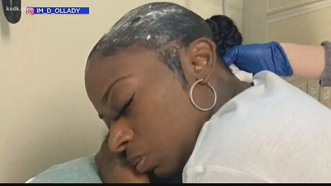 Gorilla Glue Hair Girl Gets Surgery