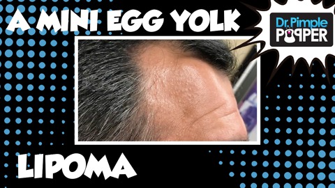 A Mini Egg-Yolk Lipoma