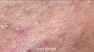 Popping Tons Of Blackheads Part 95