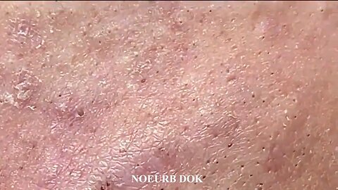 Popping Tons Of Blackheads Part 95