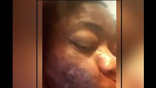 Las Vegas woman suffers painful necrosis