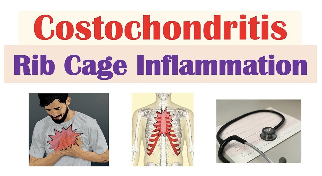 Costochondritis (Rib Cage Inflammation) Causes, Symptoms, Diagnosis