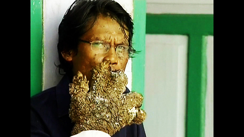 'Tree Man' Looks For Cure