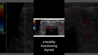 How to repair thyroid disorders?