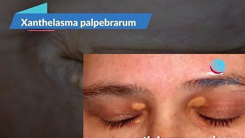 xanthelasma palpebrarum