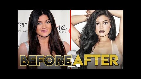 KYLIE JENNER | Before & After | Transformation ( Lips, Plastic Surgery and Workout )