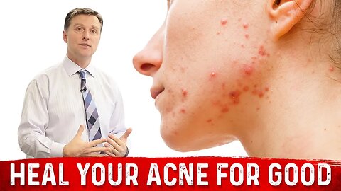 What Causes Pimples and How to Get Rid of Acne