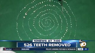 526 teeth removed from one boy's mouth?