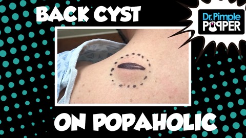 Back Cyst on a Popaholic... baby!