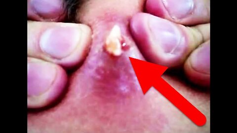 MOST SATISFYING PIMPLE BLACKHEAD 2019 POPPING HD VIDEO COMPILATION