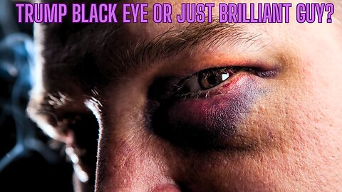 TRUMP BLACK EYE? Or Just A Brilliant Guy?