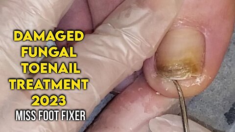 DAMAGED FUNGAL TOENAIL [ Discoloration of the Nail ] FULL TREATMENT BY MISS FOOT FIXER