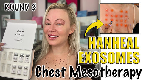 Hanheal Exosomes Chest Mesotherapy Round 3 from AceCosm.com | Code Jessica10 Saves you Money!