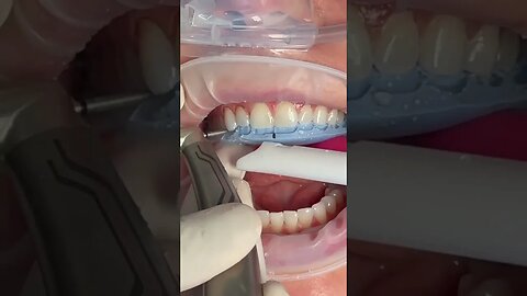 Minimal Prep Veneers