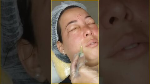 Só Relaxe Carboxiterapia Vídeos Satisfatórios - Just Relax | Apenas Relaxe