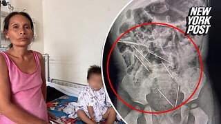 2-year-old rescued after swallowing 8 needles