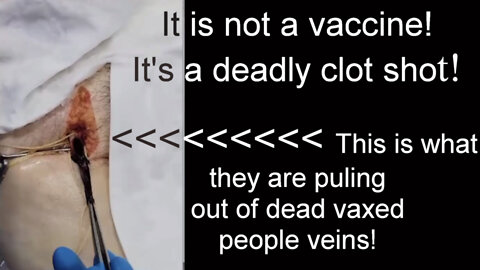 Proof it's not a vaccine, it's a DEADLY CLOT SHOT!