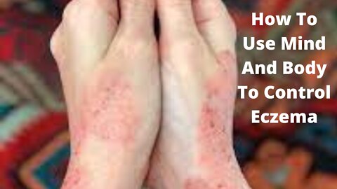 How To Use Mind And Body To Control Eczema