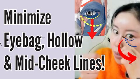 Minimize Eyebag, Hollow & Mid-Cheek Lines!