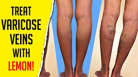 Lemon Removes Varicose Veins ! Just Do This Every Day