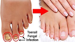 3 simple & effective natural cures for toenail fungus