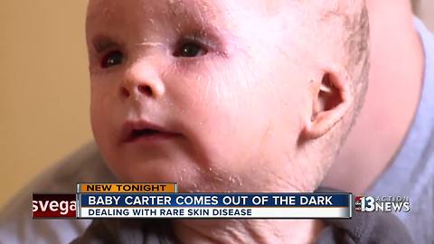 Baby Carter dealing with rare skin disease