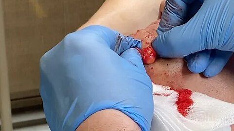Lipoma removal under the chin