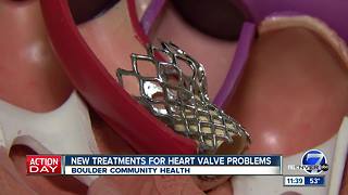Boulder community health talks about heart valve replacement procedure