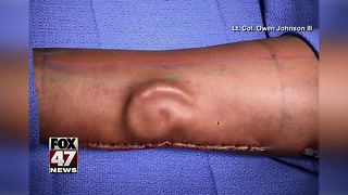 Doctors grow new ear inside patient's arm