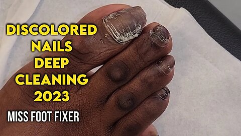 CLEANING TOENAIL 🦶🏽: DISCOLORED TOENAILS DEEP CLEANING BY FAMOUS PODIATRIST MISS FOOT FIXER