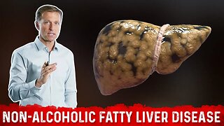 The REAL Causes of Fatty Liver Disease (NAFLD) – Dr.Berg