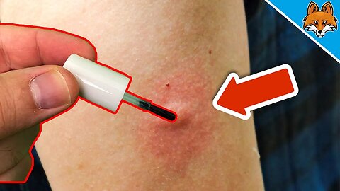 THIS will make your Mosquito Bite stop Itching IMMEDIATELY 💥 (GENIUS Trick) 🤯