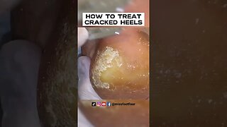 DIY DRY CRACKED HEELS 2022 | HOW TO TREAT CRACKED HEELS FULL TREATMENT BY MISS FOOT FIXER