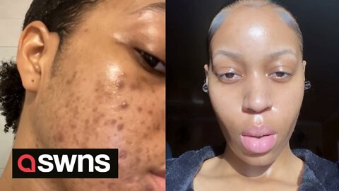 Canadian influencer cures her acne by dropping McDonalds and dairy
