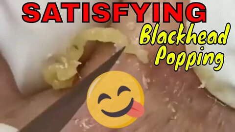 Super satisfying blackhead popping 😋🪱 #blackheadremoval #blackhead #blackheads #blackheadsremoval