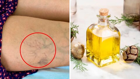 How to Get Rid of Varicose Veins With Essential Oils