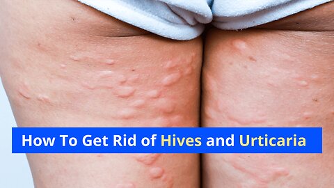 how to Cure hives and urticaria