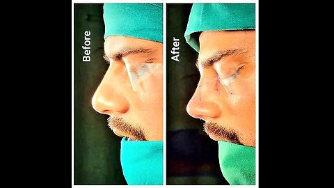 Rhinoplasty & Nasal Tip Rotation