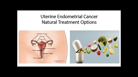 Uterine Endometrial Cancer - Natural Treatment Options