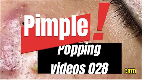 Satisfying Pimple Popping Videos 028