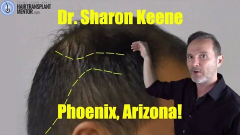 Is this the BEST Hair Transplant doc in Arizona? Dr. Keene.
