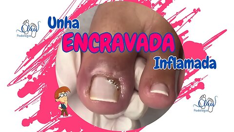 Unha ENCRAVADA infectada com PUS #unhas #pes #dor #podologia #encravada