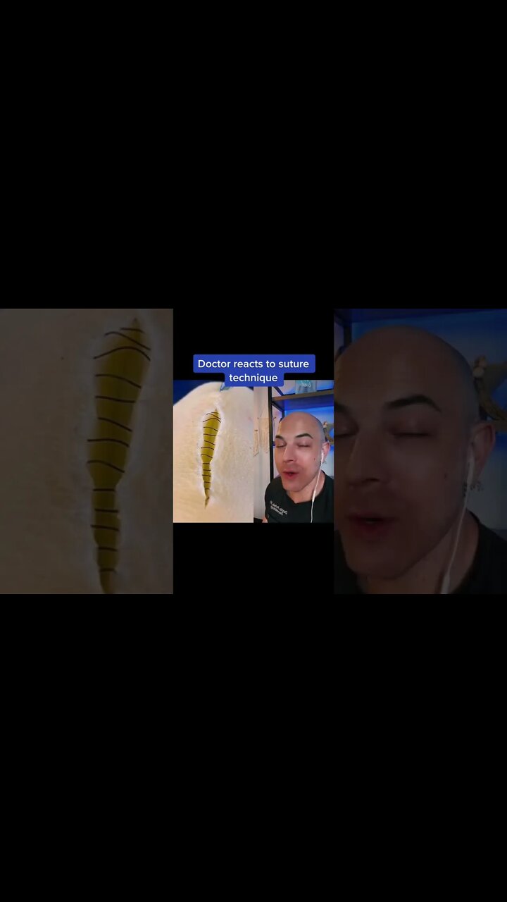 Super Satisfying Suture Technique Super Satisfying Suture Technique