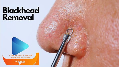 Blackhead Removal Video