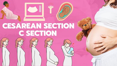 C-section animation | Cesarean section | Baby delivery animation