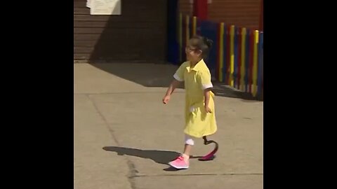 Little girl showing her friends at school her new prosthetic leg