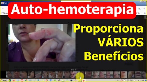 Auto-hemoterapia proporciona vários benefícios. Relato de Caso Documentado Continuação Lei de Hering